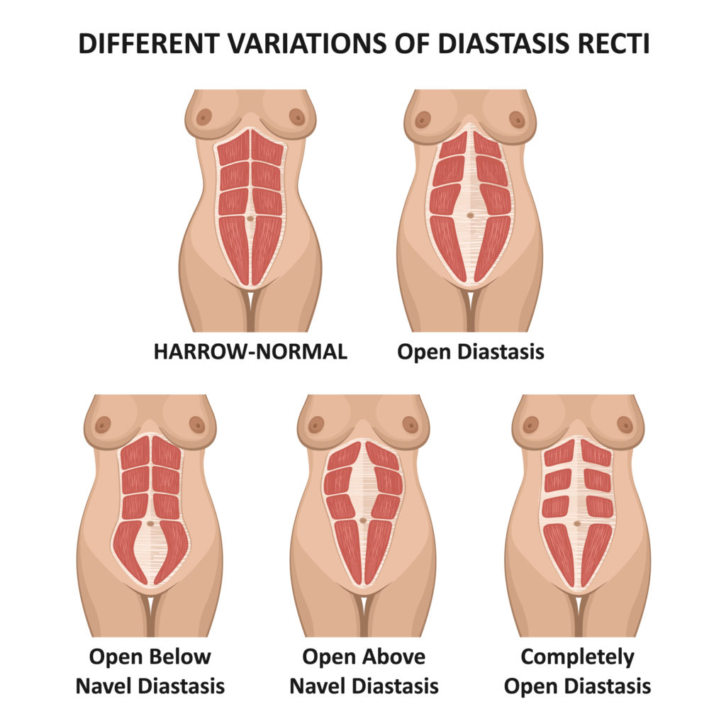 The Postpartum Body No One Tells You About | What Is Diastasis Recti